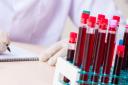 Men aged over 50 years without symptoms are able to request the blood test from their GP (Alamy/PA)